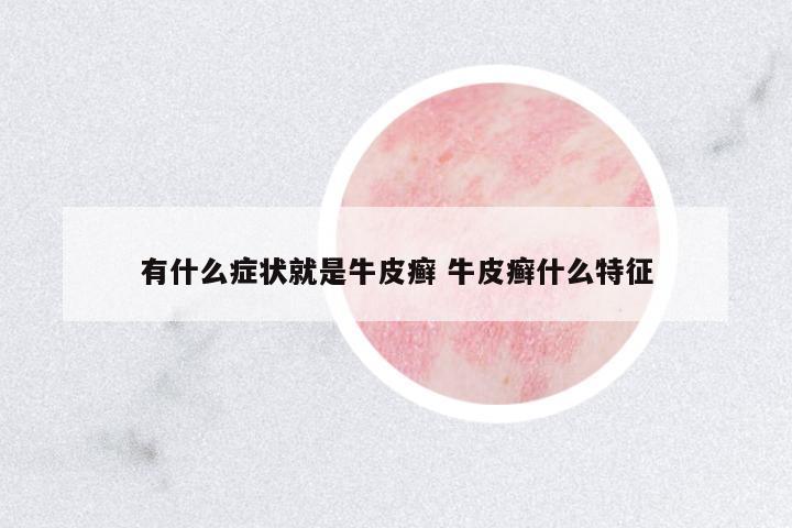 有什么癥狀就是牛皮癬 牛皮癬什么特征