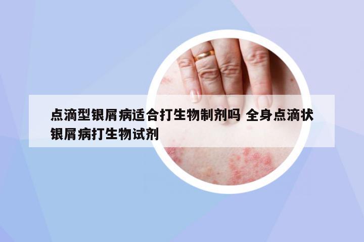 點(diǎn)滴型銀屑病適合打生物制劑嗎 全身點(diǎn)滴狀銀屑病打生物試劑