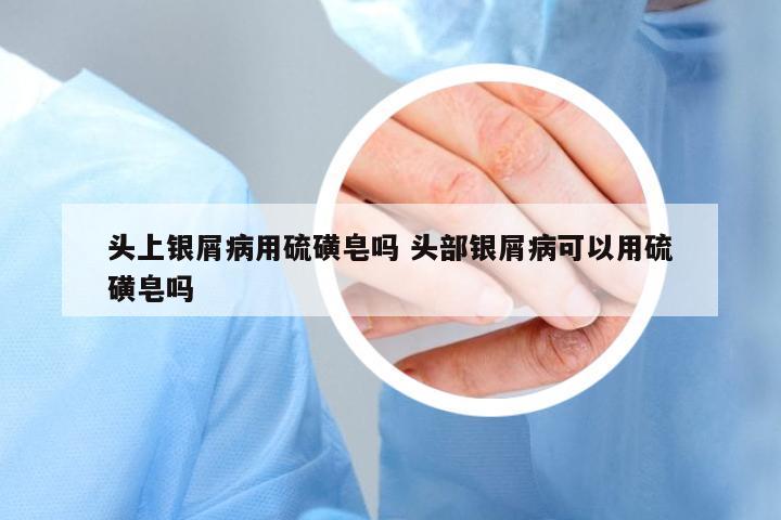 頭上銀屑病用硫磺皂嗎 頭部銀屑病可以用硫磺皂嗎