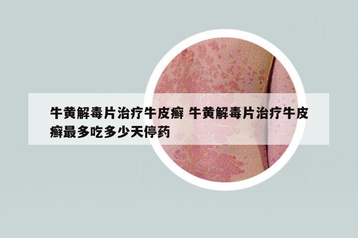 牛黃解毒片治療牛皮癬 牛黃解毒片治療牛皮癬最多吃多少天停藥