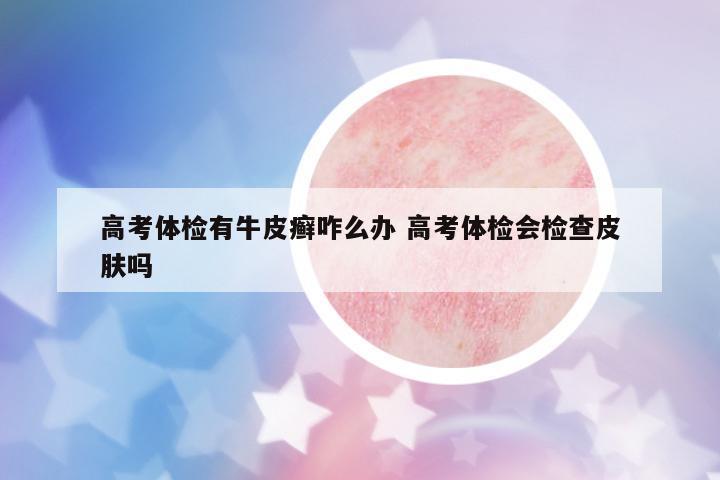 高考體檢有牛皮癬咋么辦 高考體檢會(huì)檢查皮膚嗎