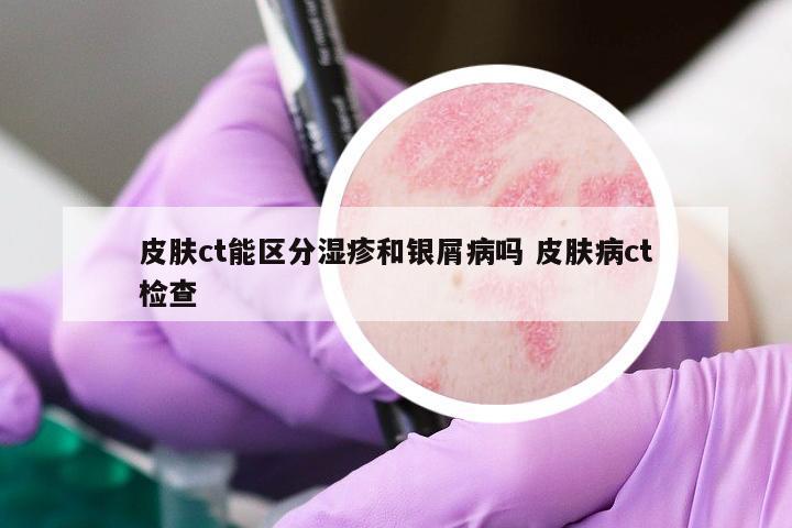 皮膚ct能區(qū)分濕疹和銀屑病嗎 皮膚病ct檢查
