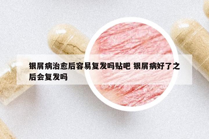 銀屑病治愈后容易復(fù)發(fā)嗎貼吧 銀屑病好了之后會(huì)復(fù)發(fā)嗎