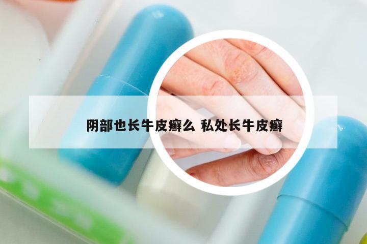 陰部也長(zhǎng)牛皮癬么 私處長(zhǎng)牛皮癬