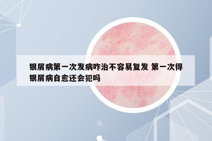 銀屑病第一次發(fā)病咋治不容易復(fù)發(fā) 第一次得銀屑病自愈還會(huì)犯嗎