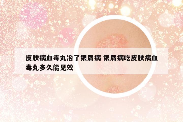 皮膚病血毒丸冶了銀屑病 銀屑病吃皮膚病血毒丸多久能見效