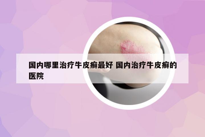 國內(nèi)哪里治療牛皮癬最好 國內(nèi)治療牛皮癬的醫(yī)院