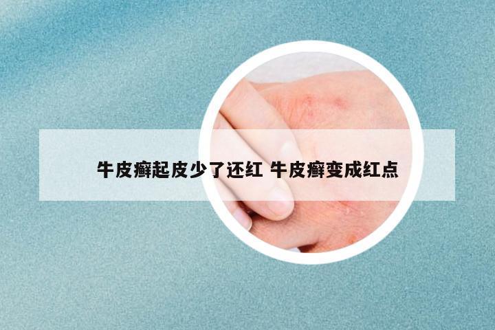 牛皮癬起皮少了還紅 牛皮癬變成紅點