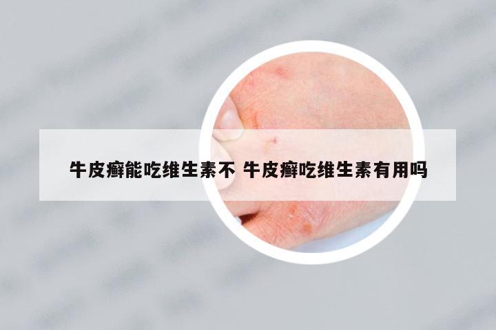 牛皮癬能吃維生素不 牛皮癬吃維生素有用嗎