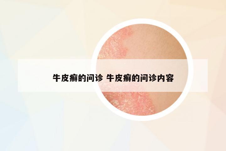 牛皮癬的問診 牛皮癬的問診內(nèi)容