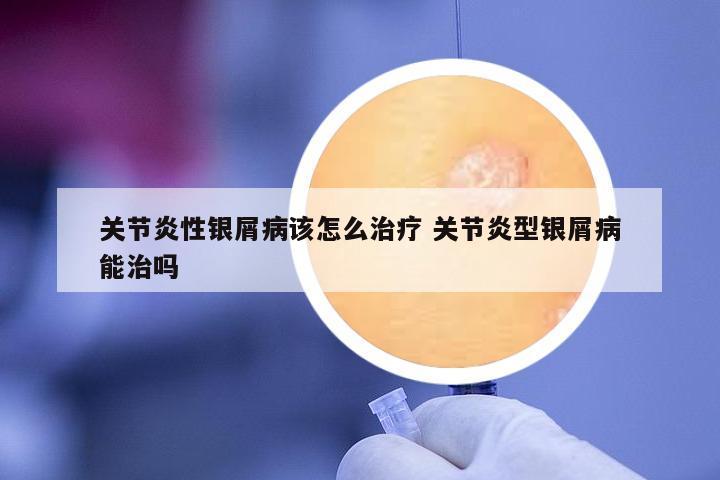 關(guān)節(jié)炎性銀屑病該怎么治療 關(guān)節(jié)炎型銀屑病能治嗎