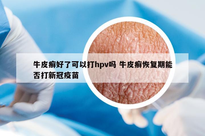 牛皮癬好了可以打hpv嗎 牛皮癬恢復期能否打新冠疫苗