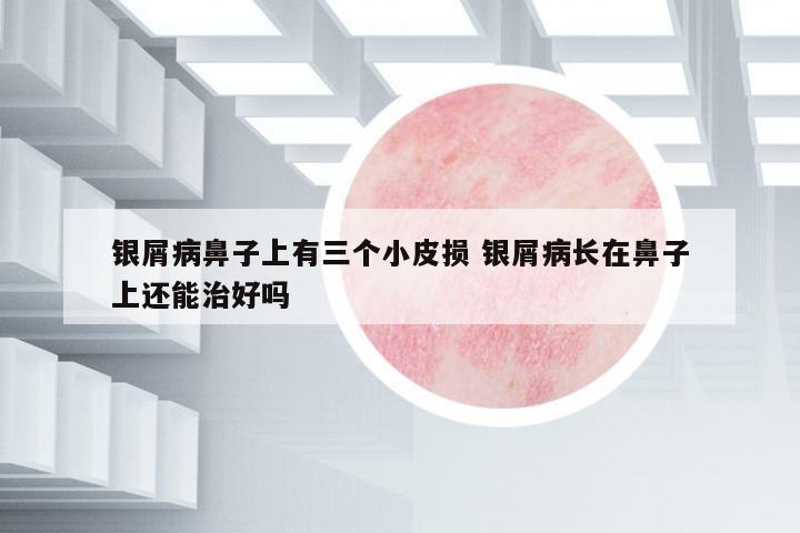 銀屑病鼻子上有三個小皮損 銀屑病長在鼻子上還能治好嗎