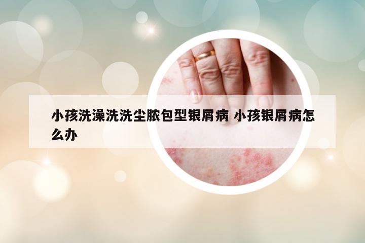 小孩洗澡洗洗塵膿包型銀屑病 小孩銀屑病怎么辦