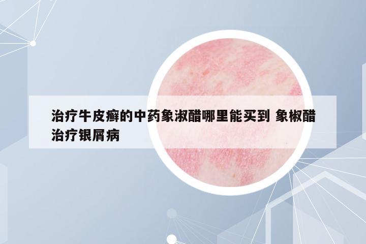 治療牛皮癬的中藥象淑醋哪里能買到 象椒醋治療銀屑病