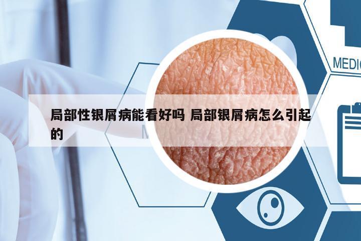 局部性銀屑病能看好嗎 局部銀屑病怎么引起的