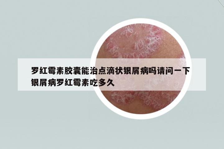 羅紅霉素膠囊能治點(diǎn)滴狀銀屑病嗎請(qǐng)問(wèn)一下 銀屑病羅紅霉素吃多久
