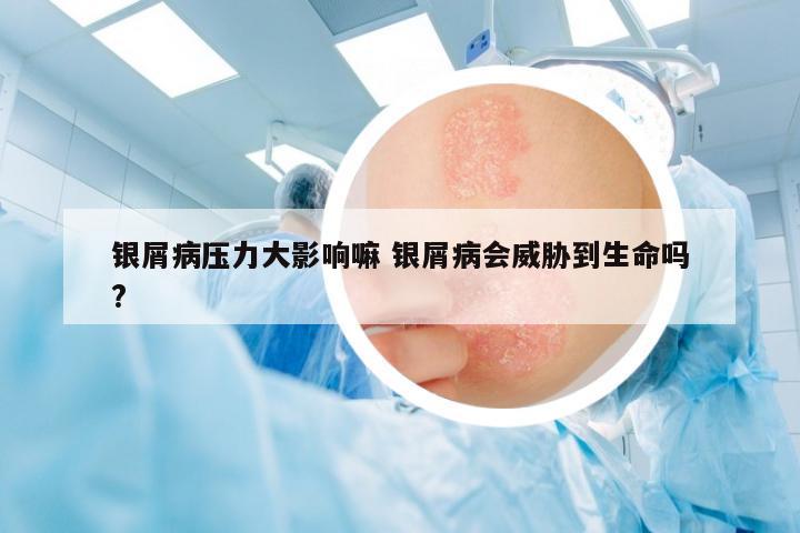 銀屑病壓力大影響嘛 銀屑病會(huì)威脅到生命嗎?