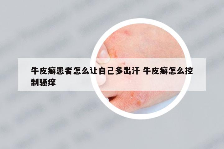 牛皮癬患者怎么讓自己多出汗 牛皮癬怎么控制騷癢