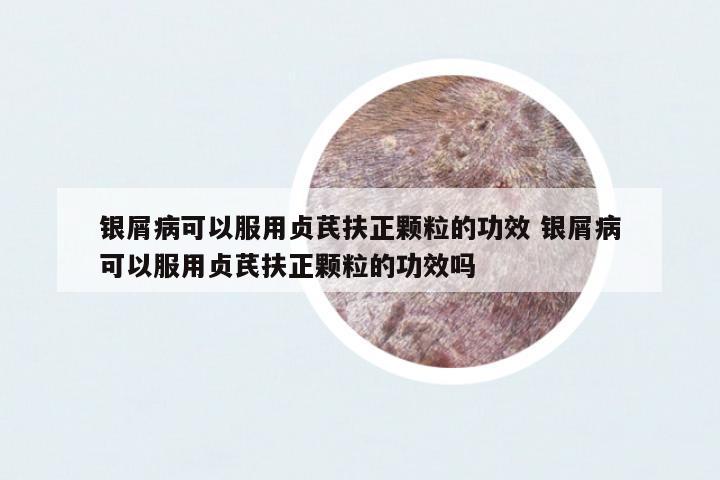 銀屑病可以服用貞芪扶正顆粒的功效 銀屑病可以服用貞芪扶正顆粒的功效嗎