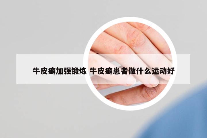 牛皮癬加強(qiáng)鍛煉 牛皮癬患者做什么運動好