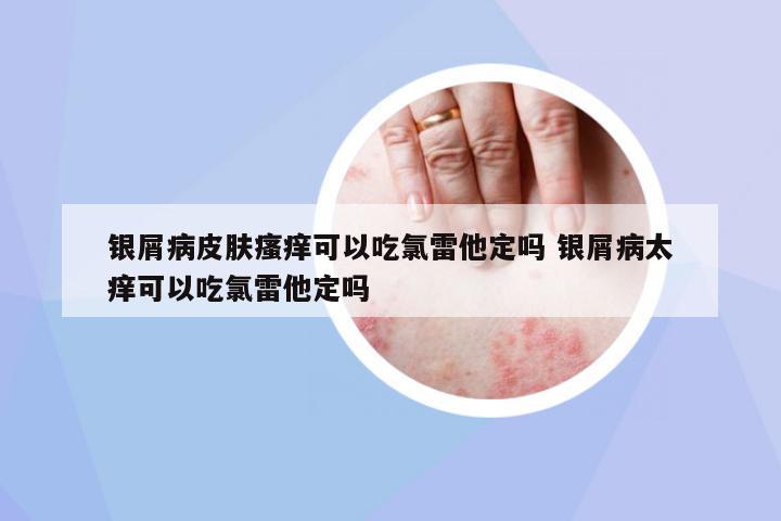銀屑病皮膚瘙癢可以吃氯雷他定嗎 銀屑病太癢可以吃氯雷他定嗎