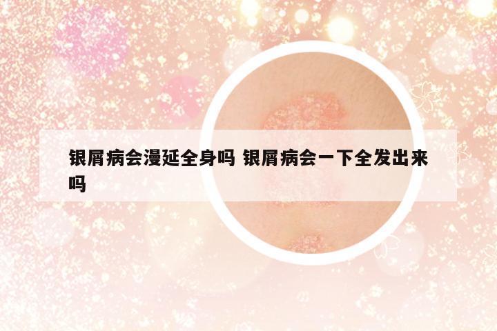 銀屑病會漫延全身嗎 銀屑病會一下全發(fā)出來嗎