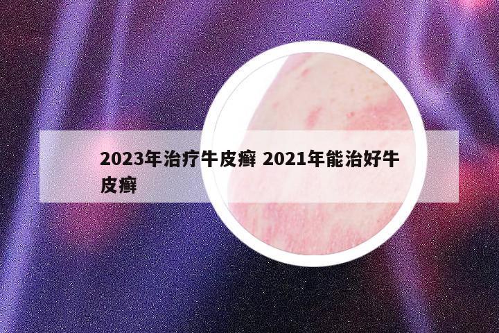 2023年治療牛皮癬 2021年能治好牛皮癬