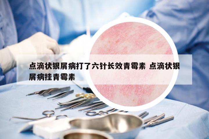 點(diǎn)滴狀銀屑病打了六針長效青霉素 點(diǎn)滴狀銀屑病掛青霉素