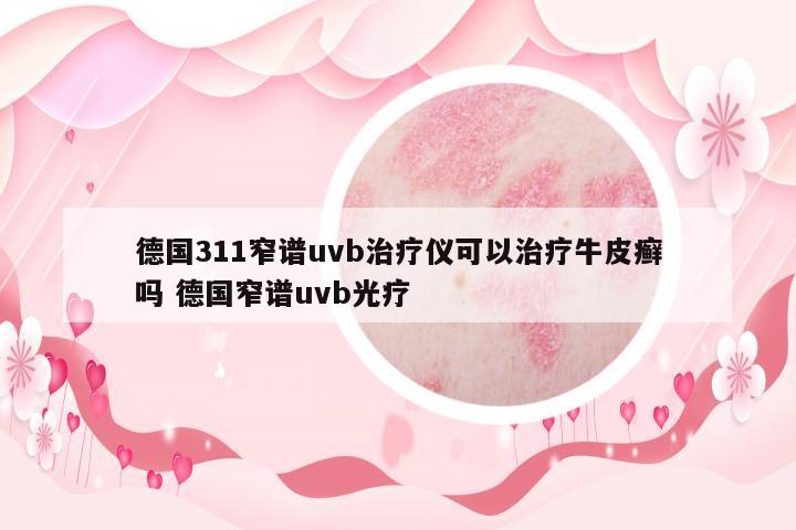德國311窄譜uvb治療儀可以治療牛皮癬嗎 德國窄譜uvb光療