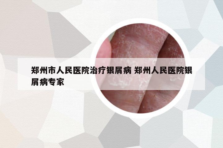鄭州市人民醫(yī)院治療銀屑病 鄭州人民醫(yī)院銀屑病專(zhuān)家